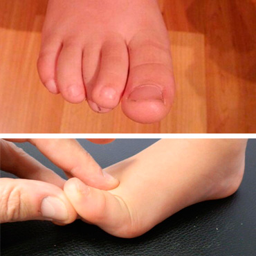 Podologia infantil Podologia infantil