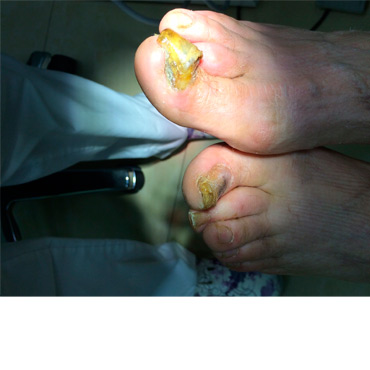 Onicomicosis Onicomicosis