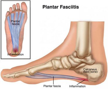 Fascitis Fascitis